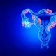 endometriosis