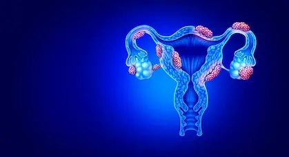 endometriosis